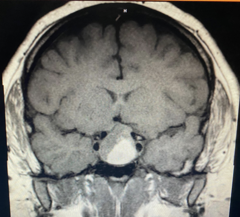 Sagittal view of CT Brain showing 2.5×2.1×2.3cm suprasellar mass.