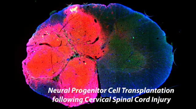 Neural Progenitor Cell Transplantation following Cervical Spinal Cord Injury