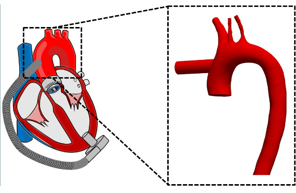 Schematic of implanted mechanical circulatory support (MCS, left). 3D model for CFD of the aorta with MCS outflow interface (right).