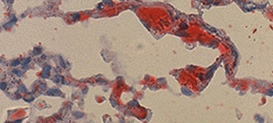 Drexel Histotechnology program image - Oil red O stain fat emboli in lung.