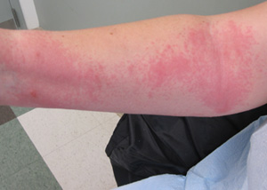 Drexel Researchers Discover Underlying Cause of Eczema