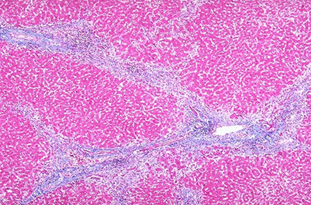 Drexel Histotechnology program image - Trichrome stain, liver, chronic active hepatitis