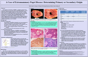 Pathologists' Assistant Research: A Case of Extramammary Paget Disease