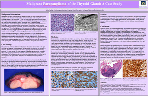 Pathologists' Assistant Research: Malignant Paraganglioma of the Thyroid Gland: A Case Study