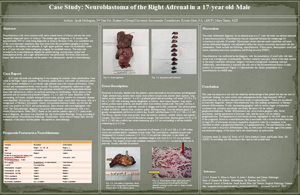 Pathologists' Assistant Research: Neuroblastoma of the Right Adrenal in a 17 Year-Old Male