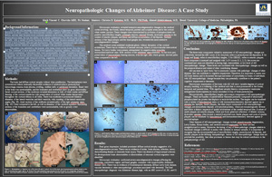 Pathologists' Assistant Research: Neuropathologic Changes of Alzheimer Disease: A Case Study