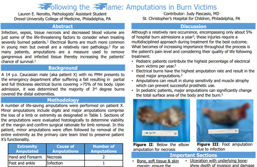 Following the Flame: Amputations in Burn Victims