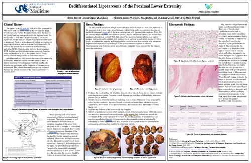 Dedifferentiated Liposarcoma of the Proximal Lower Extremity