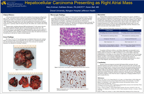 Hepatocellular Carcinoma Presenting as Right Atrial Mass