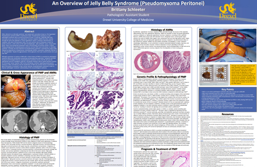 An Overview of Jelly Belly Syndrome (Pseudomyxoma Peritonei)
