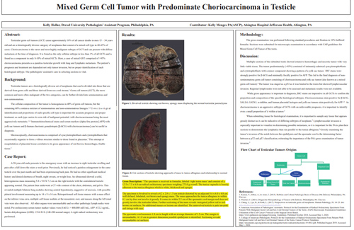 Mixed Germ Cell Tumor with Predominate Choriocarcinoma in Testicle