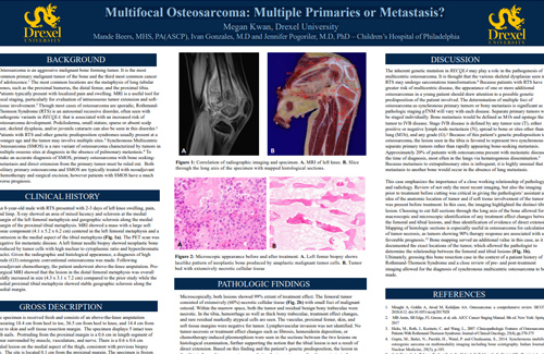 Multifocal Osteosarcoma: Multiple Primaries or Metastasis?