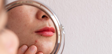 Acne on chin reflected in mirror.