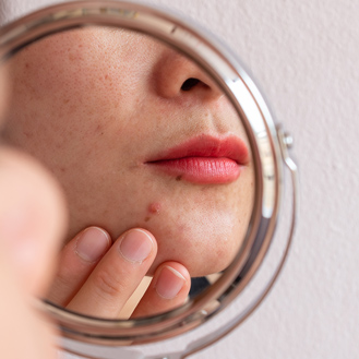 Acne on chin reflected in mirror.