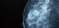 Closeup of a mammogram.