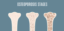 Osteoporosis Bone Density Stages Infographic
