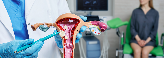 Gynecologist pointing to uterine fibroids on anatomical model of uterus.
