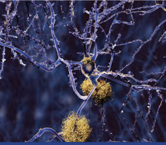 Neuron with amyloid plaques
