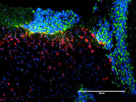 Mauricio Reginato, PhD, is working with SKCC radiation oncologist Nicole Simone, MD, to uncover novel pathways to target brain metastasis. Pictured here are breast cancer brain metastatic cells (green) and astrocytes (red) in the brain parenchyma following treatment with radiation using an ex vivo tumor model.
