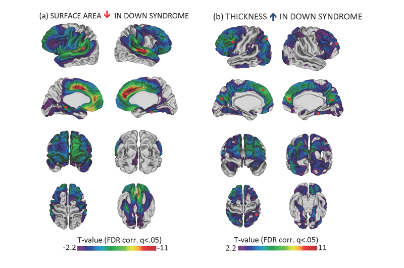 brain images show reduced cortical surface area and increased cortical thickness in Down Syndrome