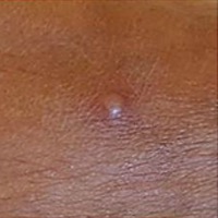 Image of monkeypox rash